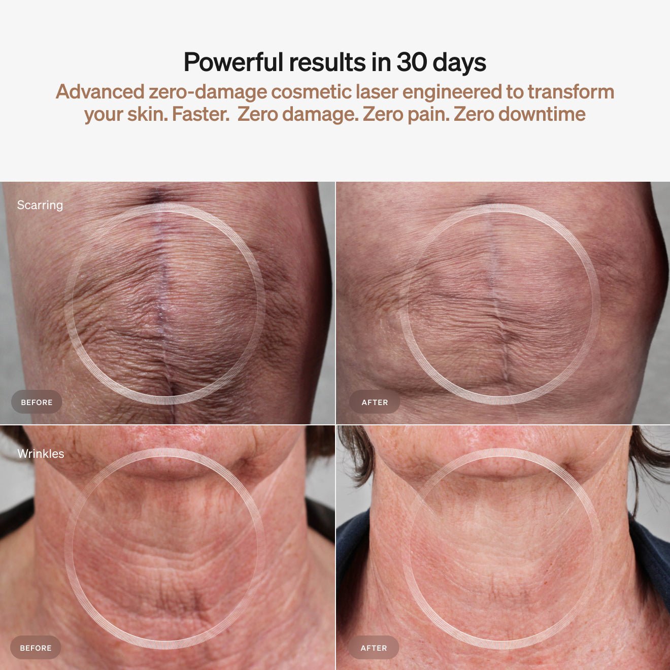 LYMA | Laser PRO - Helvetskin